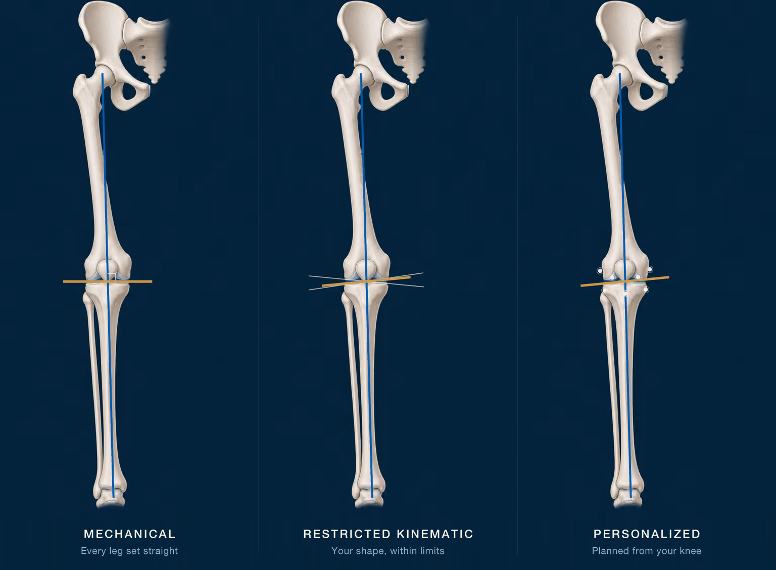 Three identical skeletal renders of the same leg side by side, labeled mechanical, restricted kinematic, and personalized: the first with a joint line drawn square to the leg's long axis, the second with the knee's own oblique joint line inside two boundary lines, the third with the joint line planned from points marked on the knee's own surfaces