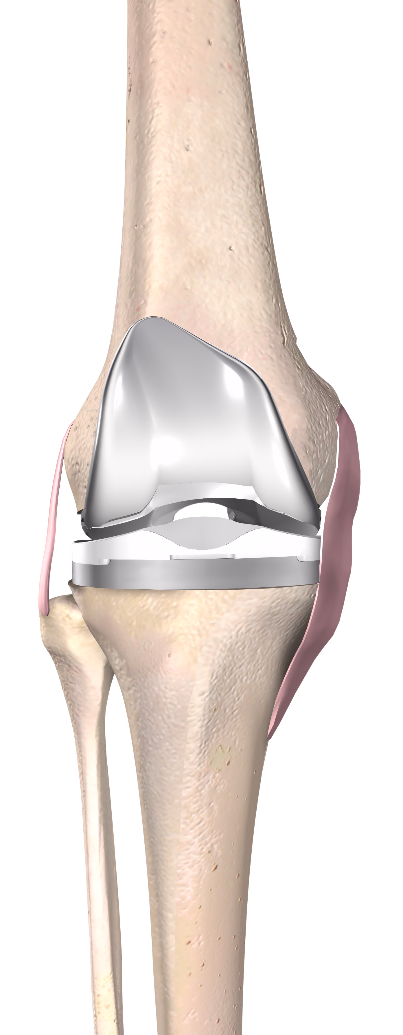 Medical illustration of an implanted total knee replacement shown within the full leg
